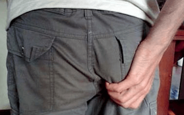 Anal itching is a symptom of parasites