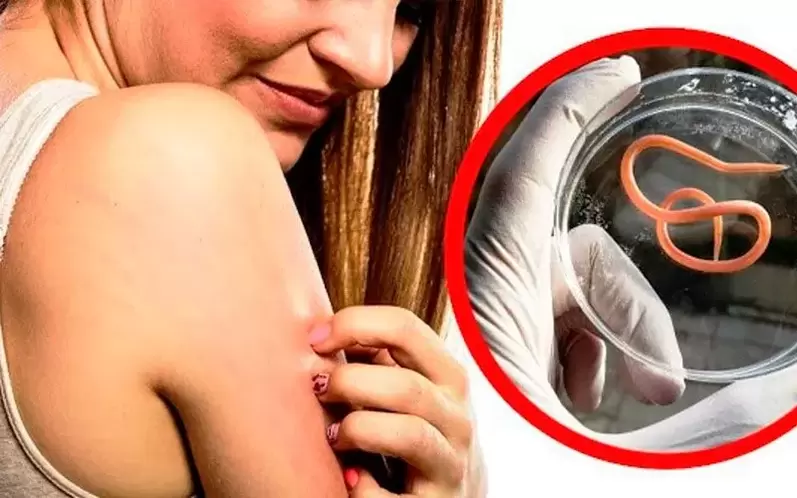 Itching and irritation due to internal parasites