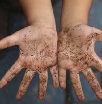 Dirty hands are the reason kids get parasites