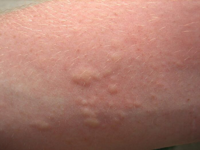 Itchy allergic rash may be a symptom of assimilation