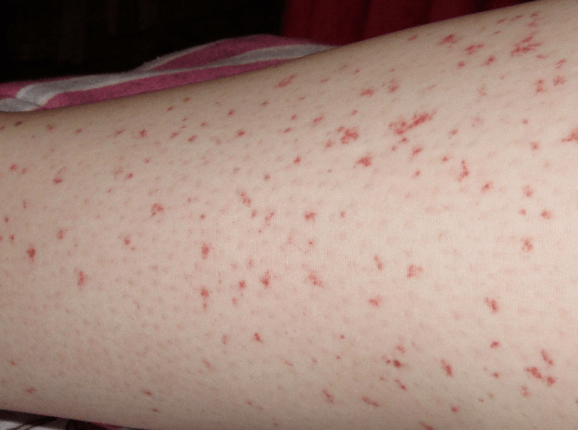 Rash is a sign of acute phase of helminth infection
